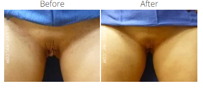 Comparison of a vulva before and after a cosmetic procedure.
