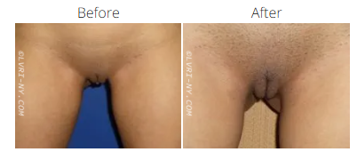 Comparison of a before and after vulva.