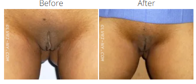 Comparison photo of a vulva before and after a procedure, showing skin color change.