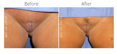 A before-and-after comparison of a vulva. The