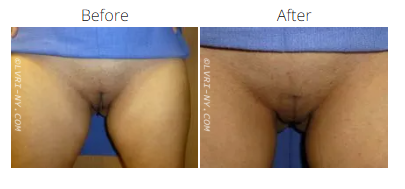 Before and after images of a woman's pubic area. The