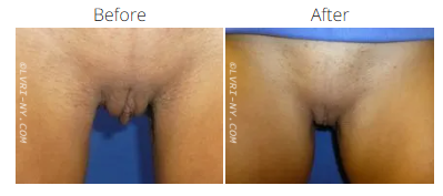 Comparison of vulva, before and after a procedure, with changes in skin appearance.
