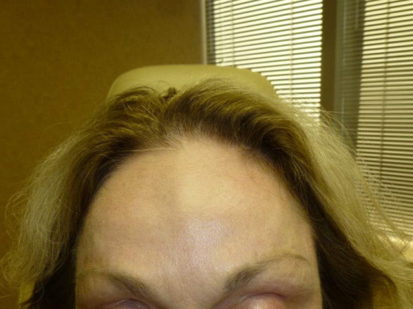 Close-up of a person's forehead and hairline, blonde hair with dark roots, indoor setting.