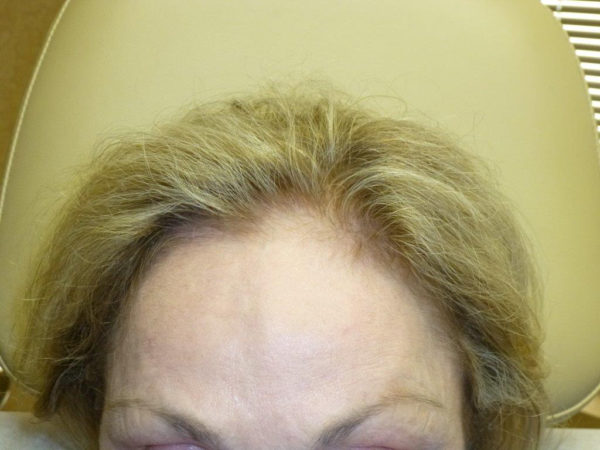 Close-up of a person's forehead and blonde hair; seated in a chair.