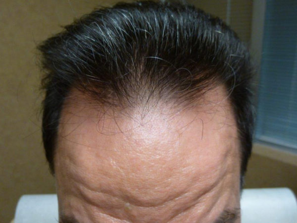 Man's forehead and hairline, showing signs of hair thinning. Dark hair, light skin, indoor setting.