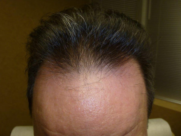 Man's receding hairline; thinning dark hair on top, showing a visible forehead.