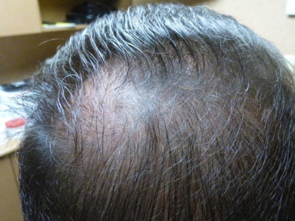 Close-up of a person's head, showing thinning dark hair and a visible scalp on top.