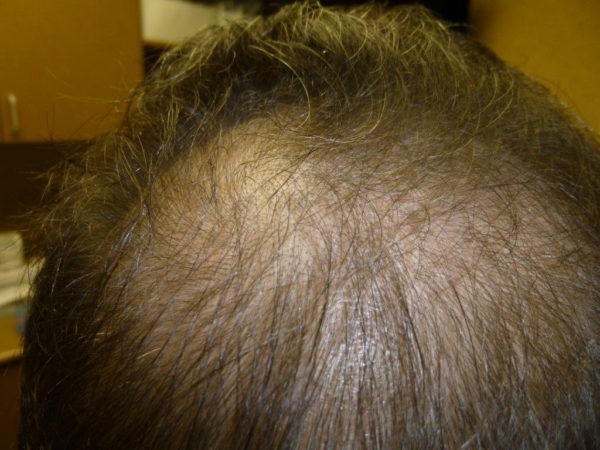 Close-up of a person's head showing thinning hair and visible scalp on the crown.