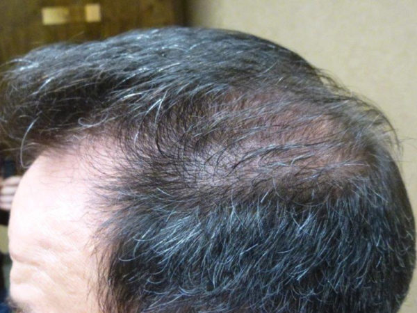 Hair loss on the crown of a person's head, with thinning dark hair.