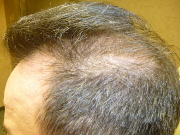Man with thinning gray hair, showing scalp at the crown and receding hairline.