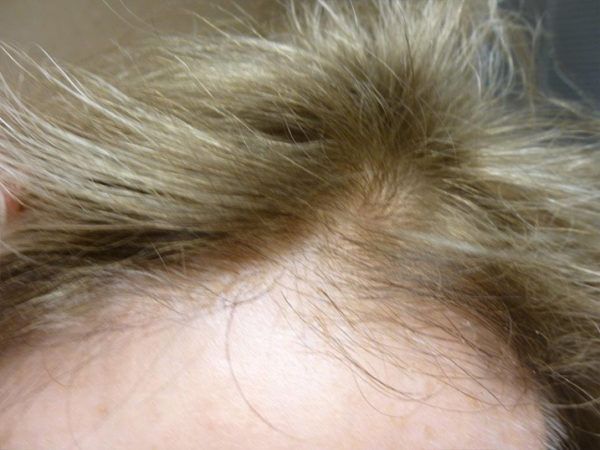 Blonde hair with visible scalp, indicating thinning or hair loss.