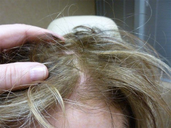Hand touching thinning blonde hair on a scalp.