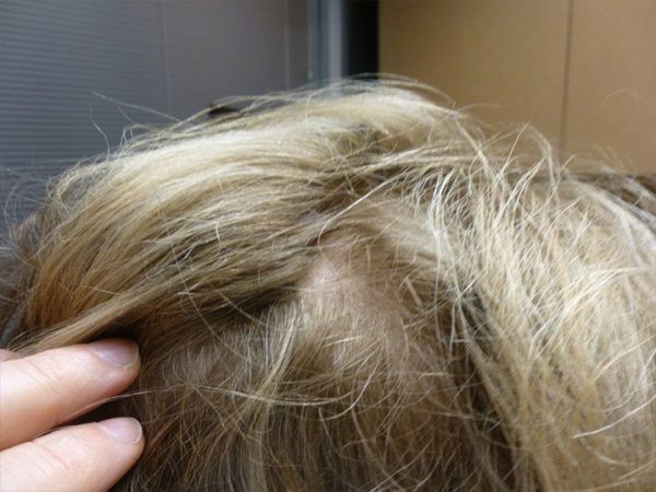 Blonde hair with a bald spot visible on the scalp. A hand is at the side of the head.