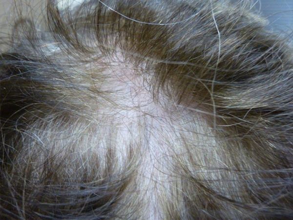Close-up of thinning gray hair on a scalp, showing exposed skin through sparse strands.
