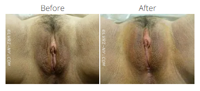 Before and after close-up of a vulva, showing a change in appearance after a procedure.
