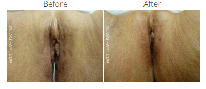 Before and after photos of a vaginal area. The “after” image has less pigmentation.