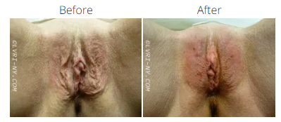 Comparison of vulva before and after treatment, showing changes in appearance.