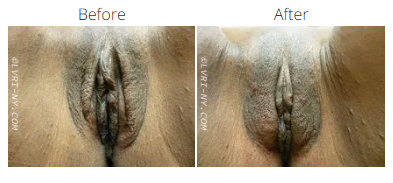 Before and after photos of a vulva, showing a change in appearance.