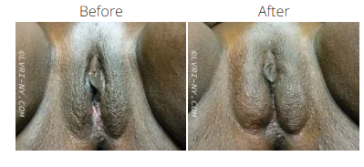 Medical before-and-after of vulva.