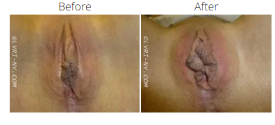 Comparison of female genitalia before and after a medical procedure.