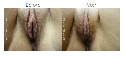 Comparison of before and after labia appearance, showing a change in color and possibly texture.