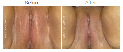 Before and after images of a vulva, showing a change in skin texture and appearance.