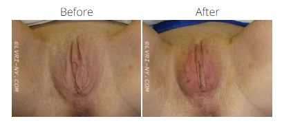 Comparison of a person's vulva before and after a procedure.