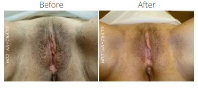 Comparison of before and after labiaplasty. The