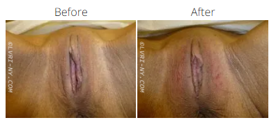 Comparison of vulva before and after a medical procedure.