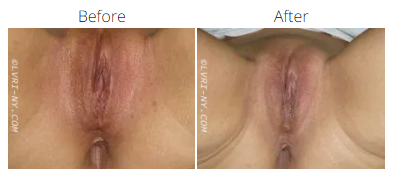 Comparison of before and after labiaplasty. The
