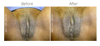 Comparison of a vulva before and after a treatment, showing a change in skin tone.