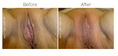 Comparison of vulva: