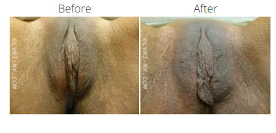 Before and after view of a vulva, showing a change in appearance.