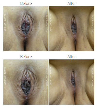 Comparison of vulva, before and after surgical procedure. Skin is visible, with stitched incision after.