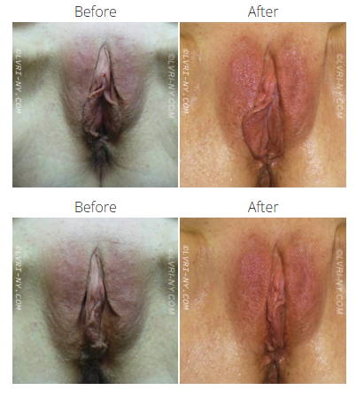 Before and after photos of a vulva, showing a change in color after treatment.