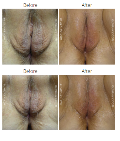Before and after comparison of a perineum, showing skin color and contour changes.