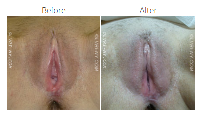 Comparison of a vulva before and after a procedure, showing changes in shape and appearance.