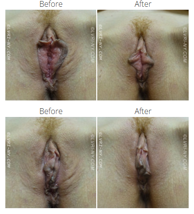 Two pairs of before and after images of a vulva, showing labiaplasty results.