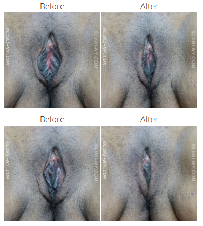 Comparison of two before and after vulva labiaplasty images.