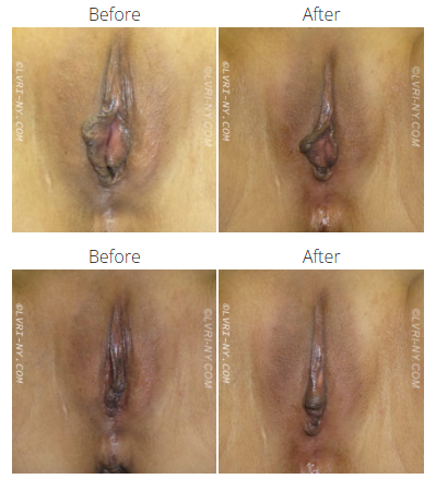 Two sets of before and after photos of a vulva. Changes appear to be cosmetic.