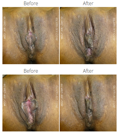 Before and after comparison of female labia, showing a surgical procedure.