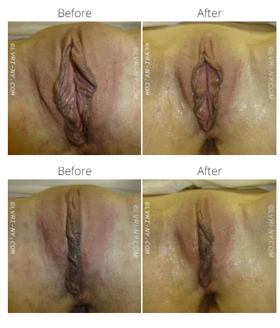 Before and after view of a vulva, showing changes in appearance.
