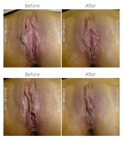 Four pairs of before-and-after photos of a vulva, showing a change in appearance after a procedure.