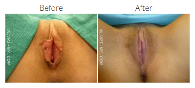 Before and after photos of a vulva. The