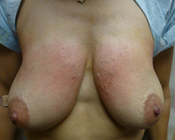 Close-up of a person's chest, showing breasts with visible redness and skin texture.