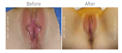 Comparison of a vulva before and after labiaplasty.