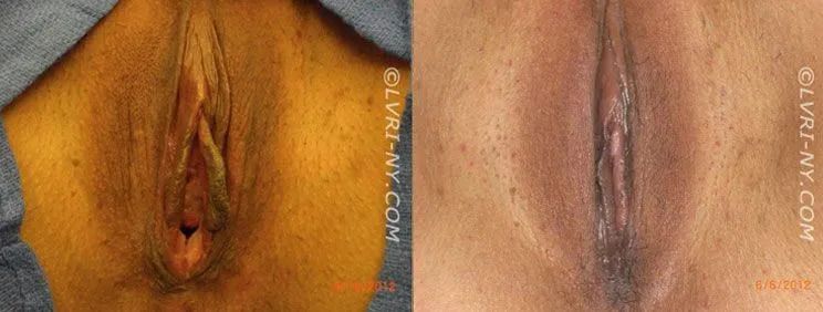 Medical images of the vulva before and after surgery.