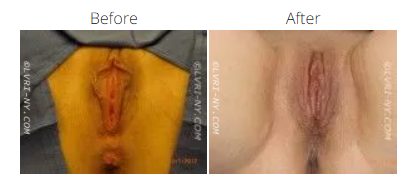 Medical illustration comparing a vulva