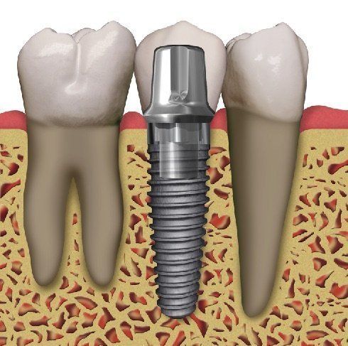 An illustration of a dental implant between two teeth