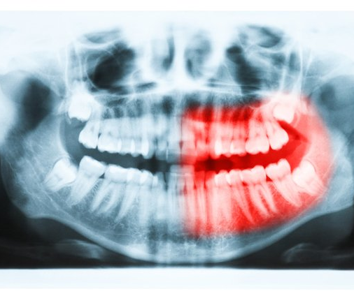 An x-ray of a person 's teeth with a red spot in the middle.